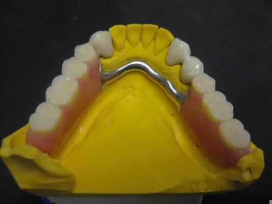 Răng giả
